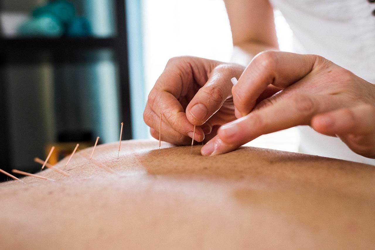 Acupuncture insurance