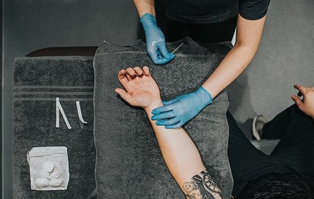 Acupuncture treatment on a forearm, with cotton balls and tape placed nearby, a client is lying down on a towel.